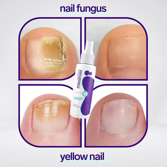 Nail Fungus Spray | بخاخ علاج فطريات الأظافر