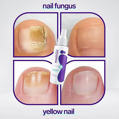Nail Fungus Spray | بخاخ علاج فطريات الأظافر