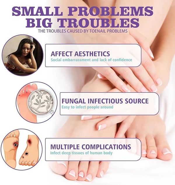 Nail Fungus Spray | بخاخ علاج فطريات الأظافر